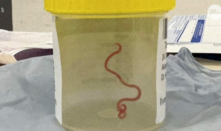 Doctors pluck roundworm parasite from woman's brain during biopsy