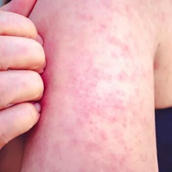 Measles warning: Cases rising across all of England as parents warned to get kids vaccinated