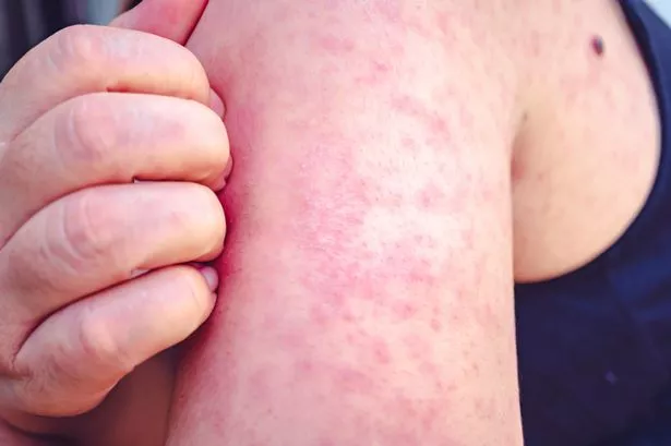 Measles warning: New hotspot identified as cases soar - all the symptoms you need to know