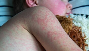 Measles rash on the body of the child. Allergy. Pic: iStock
