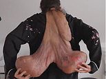 Woman's rare disease causes 20-pound tumor to grow out of her neck - the mass is so large she carries it around in a sling