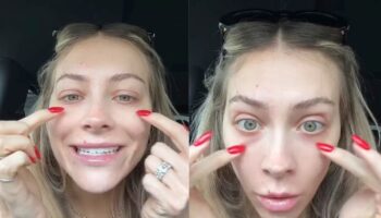 Woman shares why she regrets getting under eye filler