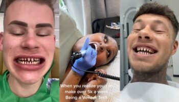 Sur TikTok, de faux dentistes liment les dents de leurs patients