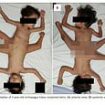 Ultra rare 'spider twins' have three legs, four arms and one penis