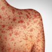 Traveler infected with confirmed case of measles at Seattle International Airport as cases in US increase