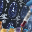 Alzheimer : de nouveaux résultats prometteurs pour un test sanguin, «avoir un diagnostic le plus accessible possible est crucial»