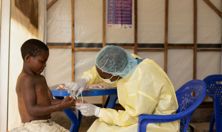 Une souche mortelle du virus de la Mpox se propage au-delà de la RDC