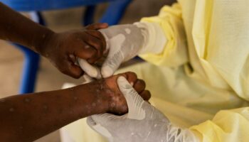 Afrika: WHO ruft wegen Mpox weltweite Notlage aus