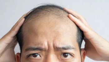 Expert shares how common drink could be affecting male hair loss