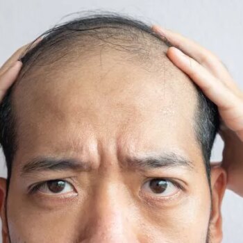 Expert shares how common drink could be affecting male hair loss
