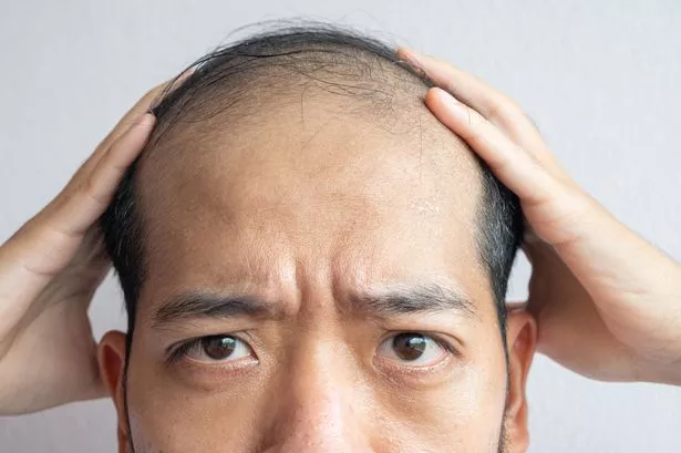 Expert shares how common drink could be affecting male hair loss