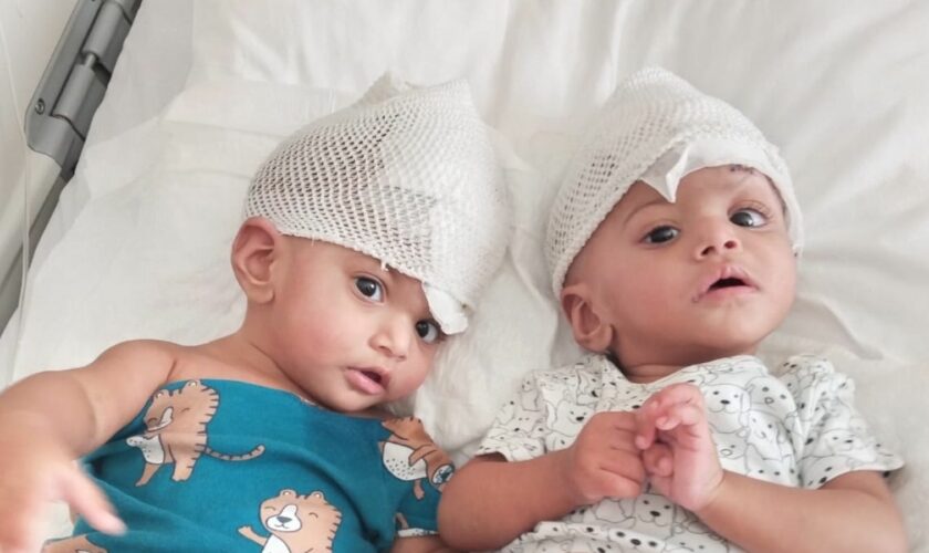 Conjoined one-year-old twin girls Minal and Mirha who were separated during an operation at Ankara Bilkent City Hospital in Turkey on 19 July 2024. Work was supported by Gemini Untwined, a charity founded by Professor Noor ul Owase Jeelani from Great Ormond Street Hospital. handout from charity