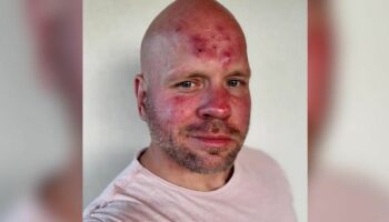 Hauterkrankung: Ricardo Lange über Rosacea: "Schmerzen kann ich aushalten, aber ich schäme mich"