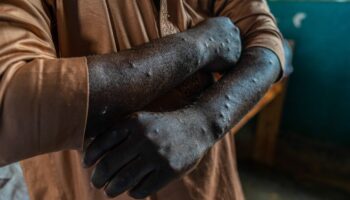 Un patient infecté par le mpox montre ses lésions dans un centre médical de Kamituga, dans l'est de la République démocratique du Congo, le 20 septembre 2024