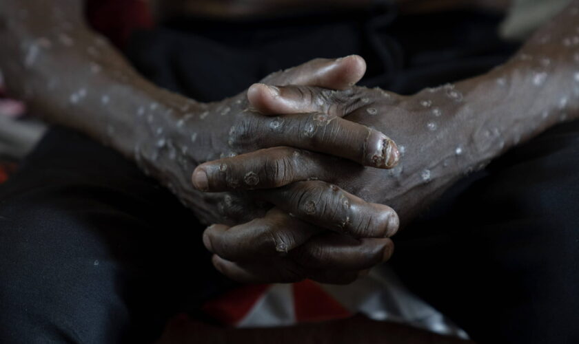 Symptômes, variant, situation en France… 4 questions sur le mpox